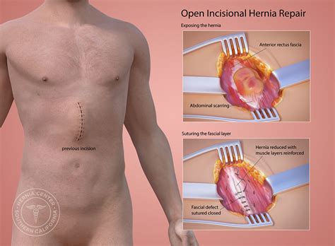 Incisional Hernia Repair Procedure Description | MyMediTravel Knowledge