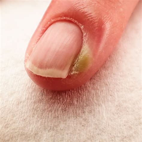 Paronychia Treatment | Nail Repair Gel | Drs. Kline + Green™