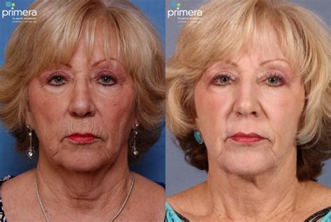 Blepharoplasty Before and After Pictures Case 118 | Orlando, Florida ...