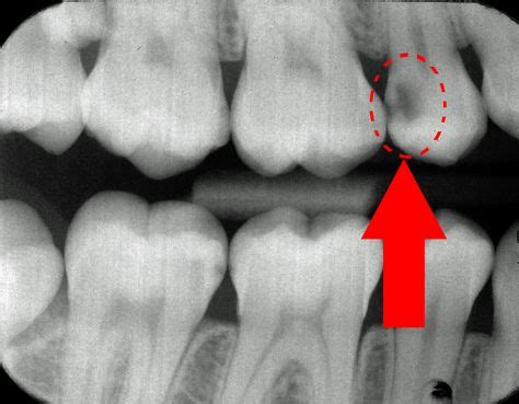 Bitewing X-rays Bitewing X-rays are an essential part of your dental ...