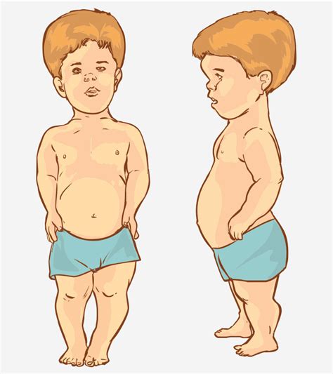 Dwarfism In Children: Types, Causes, Symptoms And Treatment – The ...