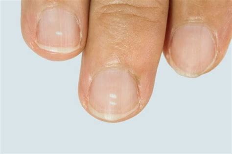 Hair Loss And Weak Nails: Causes, Treatments