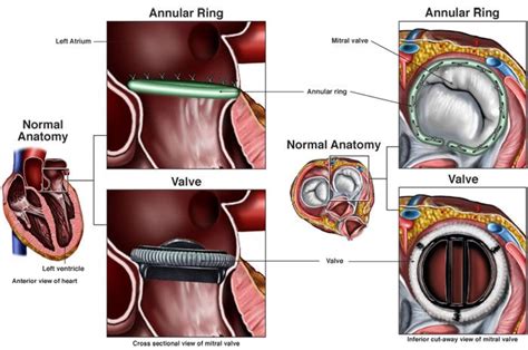 Mitral Valve Repair or Replacement | Heart and Vascular Care | NJ