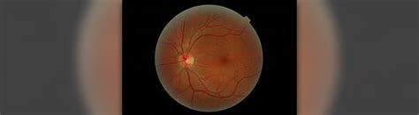 Eye disease - Retinopathy symptoms | Eye Disorders and Diseases articles | Body & Health ...