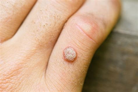 How To Get Rid Of A Wart for Good - Northstar Dermatology