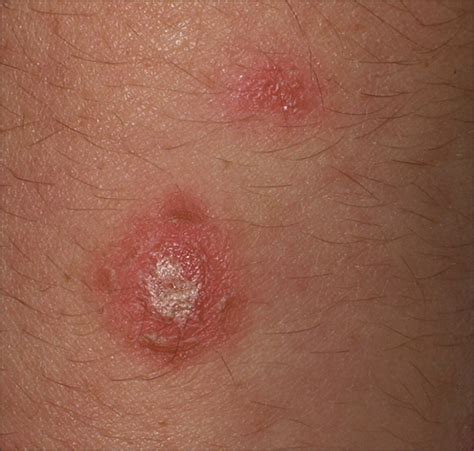 Dermoscopy Subpatterns of Inflammatory Skin Disorders | Dermatology | JAMA Dermatology | The ...