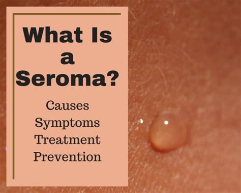 Seroma: Causes, Symptoms, Treatment, and Prevention - YouMeMindBody