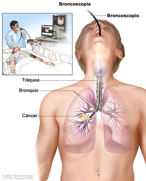 Tratamiento del cáncer de pulmón de células pequeñas - NCI