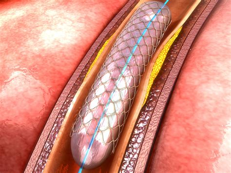 Stents don’t prevent future heart attakcs - Easy Health Options®