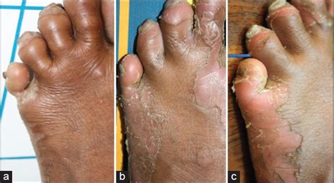 Indian Journal of Dermatology, Venereology and Leprology - Reversal of pseudo-ainhum with ...