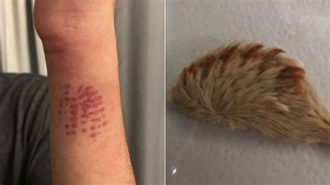 Florida teen lands in emergency room after encounter with venomous ...