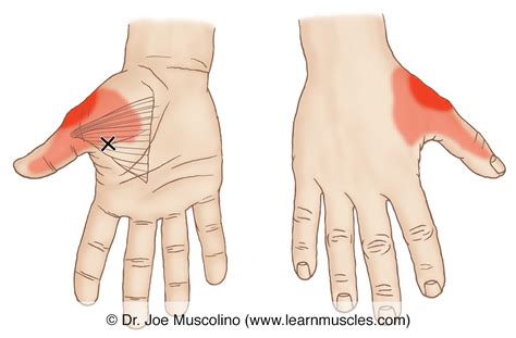 Adductor Pollicis - Trigger Points - Learn Muscles