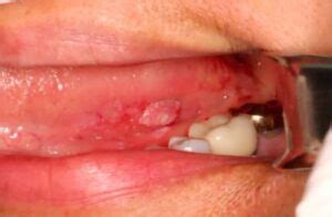 Squamous Cell Carcinoma Pictures of the Oral Cavity