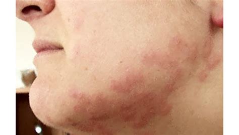 Images Of Bed Bug Bites On Face - Pest Phobia