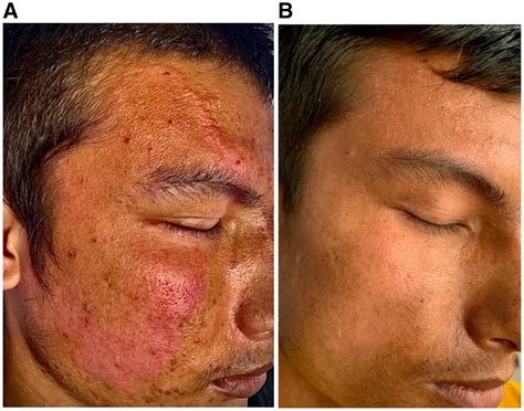 Leprosy Before And After Treatment