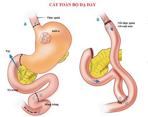 Indications for total gastrectomy | Vinmec