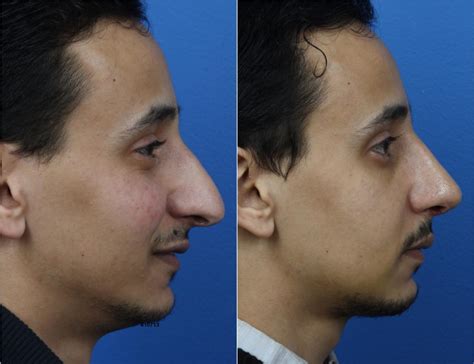 8 Common Signs of a Bad Rhinoplasty - Philip Miller MD