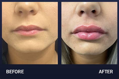 Lip Filler Before & After Pictures | Madnani Facial Plastic Surgery