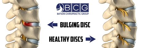 Herniated Discs, Pinched Nerves, and Bulging Discs | Batson ChiroHealth Group