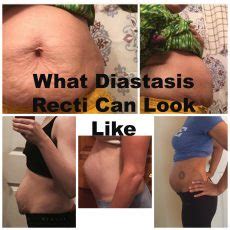 what diastasis recti can look like 2 - CarrieFit