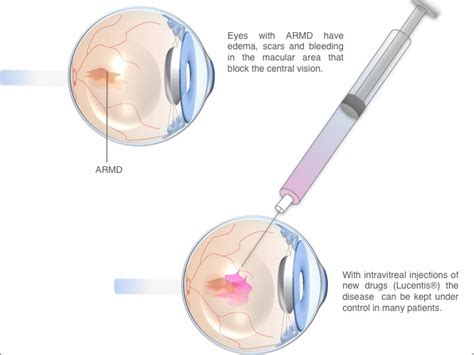 Age-related Macular Degeneration Treatment | Harley Street | Clinica London