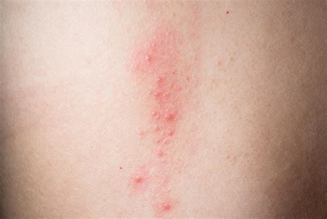 Itchy Rash On Upper Chest