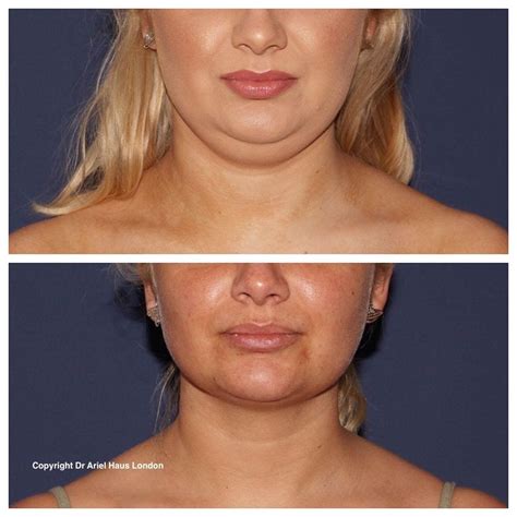 Chin Fat | Double Chins | Dr. Haus Dermatology