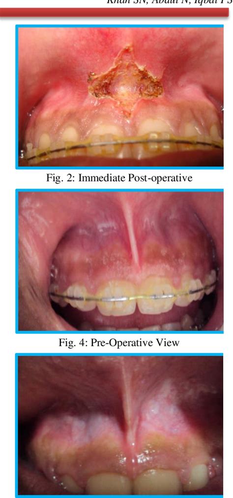 Figure 1 from MAXILLARY LABIAL FRENECTOMY USING DIODE LASER-REPORT OF TWO CASES | Semantic Scholar