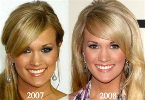 Carrie Underwood Plastic Surgery Before and After Photos - Latest ...