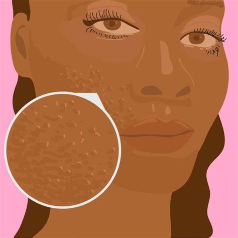 Rosacea in Black and Darker Skin: Best Treatments