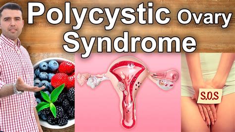 PCOS Natural Treatment - How to Cure Ovarian Cysts With Home Remedies, Diet, and Supplements ...