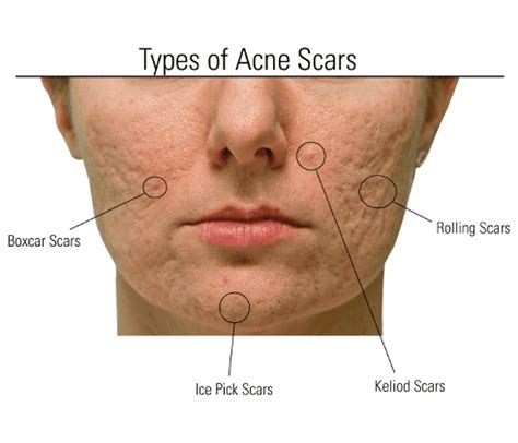 3 Effective Procedures for Treating Acne Scars - Integrative Medicine, Laser and Aesthetics