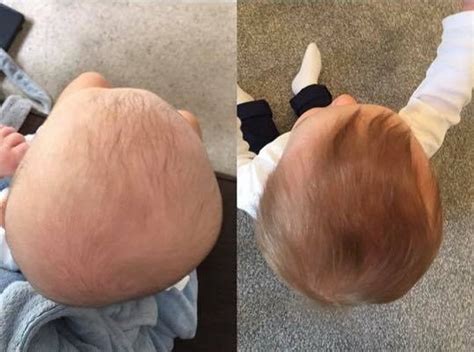 Plagiocephaly Before and After Treatment Pictures