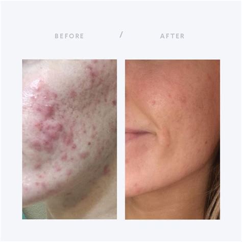 "I've struggled with acne since 7th grade so this is actually a miracle” A miracle?! Those are ...