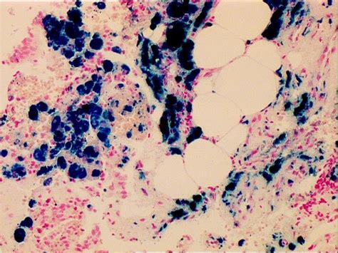 a, b: Histological findings of hemosiderosis of the lung | Download ...