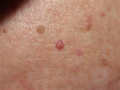 Basal Cell Carcinoma - Causes, Types, Symptoms, Prognosis, Treatment