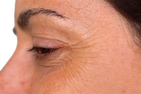 Crow's Feet Botox Treatment | Facial Aesthetics