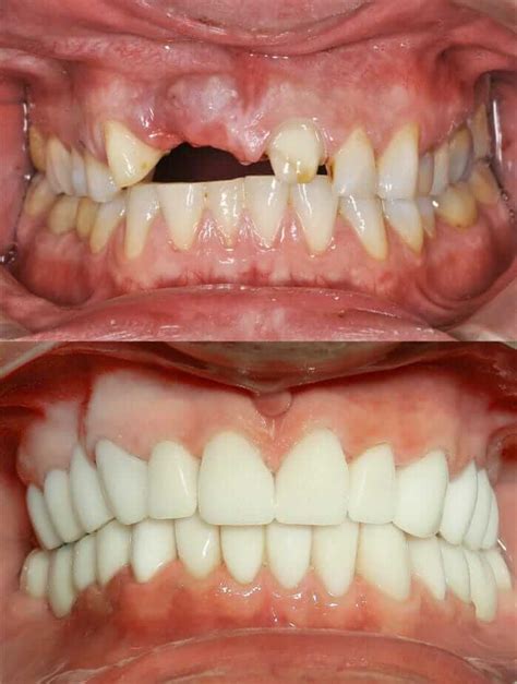 Periodontal Disease - Stages of Periodontal Disease - Before and After