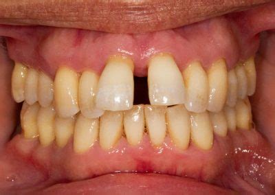 Gum disease symptoms and treatment - Cuckfield Dental