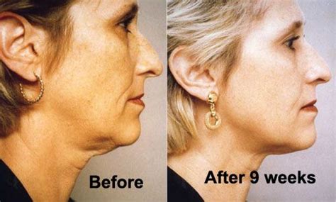 Neck Exercises | Exercise For Turkey Neck To Fight Wrinkles | Face exercises, Turkey neck ...