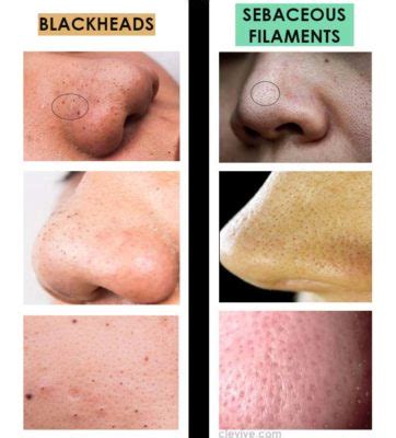 What is the difference between a blackhead & a sebaceous filament – Clevive