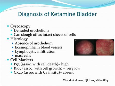 PPT - Ketamine Bladder PowerPoint Presentation, free download - ID:3797846