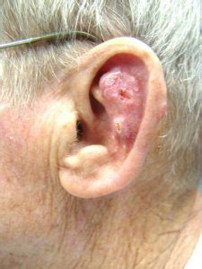 Ear Cancer & Temporal Bone Pain – A Simple & Best Guide