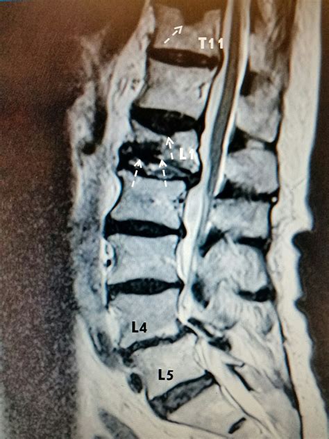 Cureus | Delayed Recognition of Thoracic and Lumbar Vertebral ...