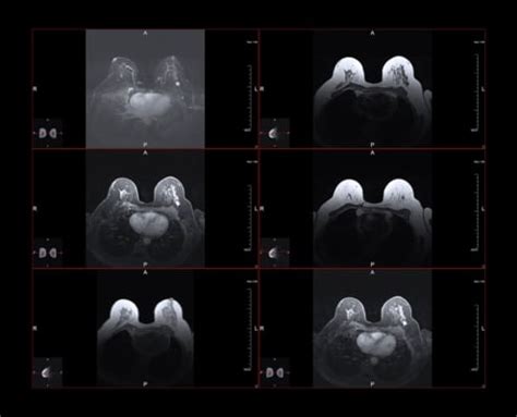 Breast MRI | Radiology of Indiana