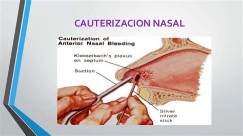 EPISTAXIS SANGRADO NASAL-DR. OMAR GONZALES SUAZO