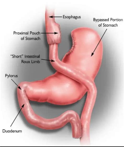 Laparoscopic Roux-en-Y Gastric Bypass - Michigan Bariatric Surgery