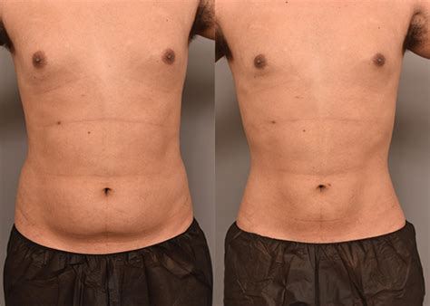 Liposuction Before And After Men