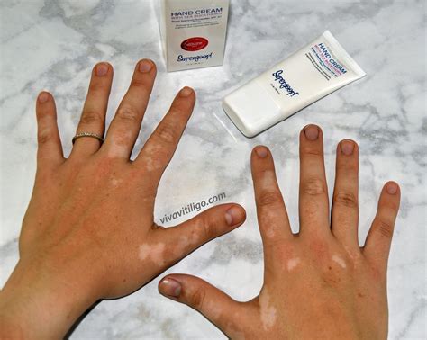 Terbaru 24+ Vitiligo Hands