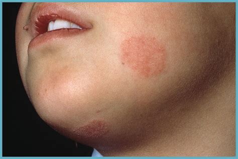 Fungal Rash On Skin